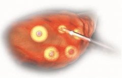 第五步：安全取卵