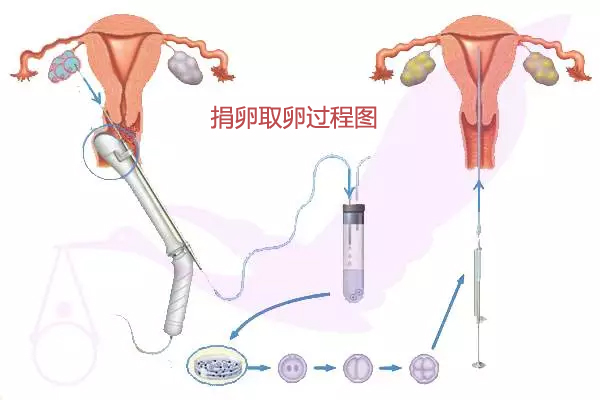 代妈取卵过程图
