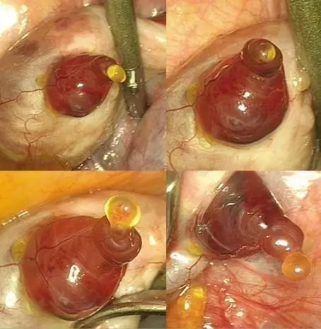 外科手术过程中,意外观察到正在排出的卵子